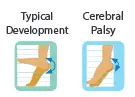 Increased sarcomere length, but reduction in number